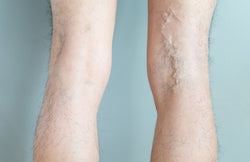 Cosmetic vs. Medical Vein Treatments: What’s the Difference?