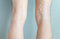 Cosmetic vs. Medical Vein Treatments: What’s the Difference?
