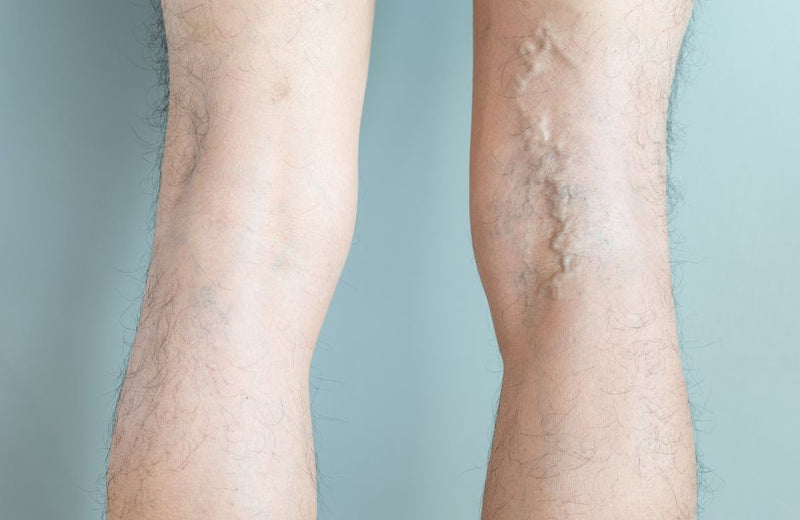 Cosmetic vs. Medical Vein Treatments: What’s the Difference?