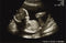 A Brief History of Ultrasound Used for Pregnancy