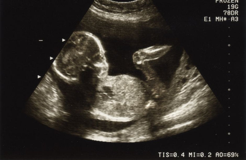 A Brief History of Ultrasound Used for Pregnancy