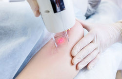 Basic Guide To Buying Cosmetic Laser Equipment
