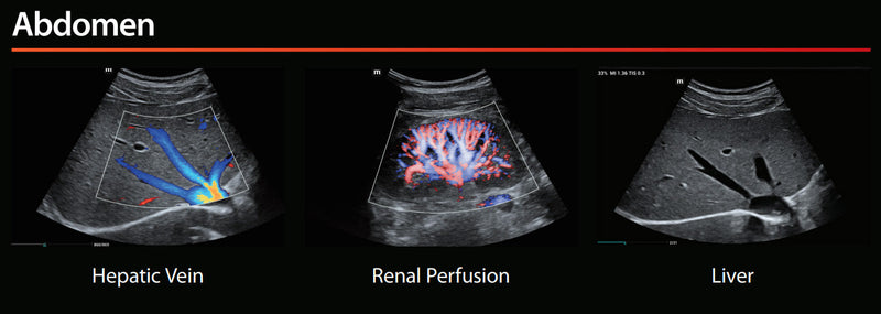 Mindray MX7 Ultrasound VASCULAR PACKAGE 1 Probe