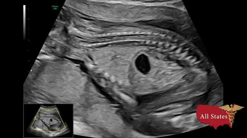 GE VOLUSON E8 Refurbished WITH 3 Probes-Ultrasounds-All States M.E.D.