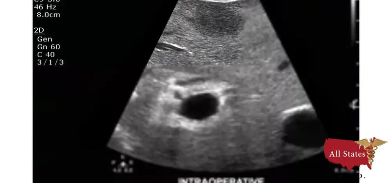 Philips CX50 Refurbished with 3 Probes-Ultrasounds-All States M.E.D.