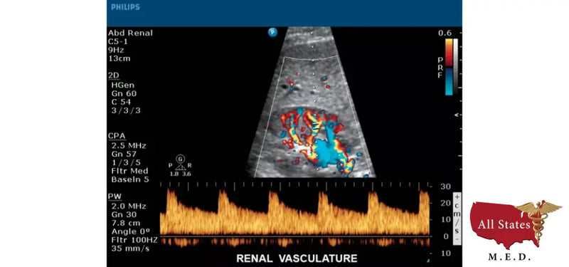 Philips CX50 Refurbished with 3 Probes-Ultrasounds-All States M.E.D.