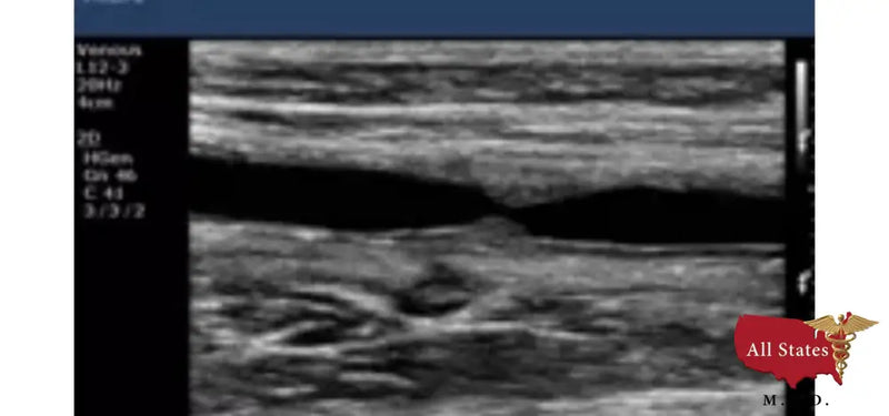 Philips CX50 Refurbished with 3 Probes-Ultrasounds-All States M.E.D.