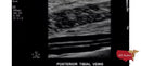 Philips CX50 Refurbished with 3 Probes-Ultrasounds-All States M.E.D.