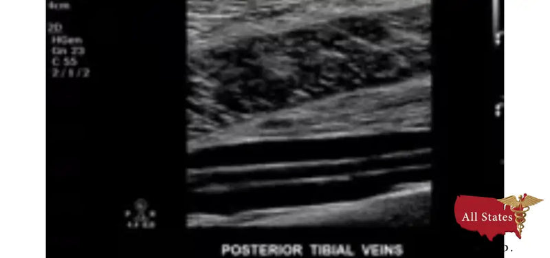 Philips CX50 Refurbished with 3 Probes-Ultrasounds-All States M.E.D.