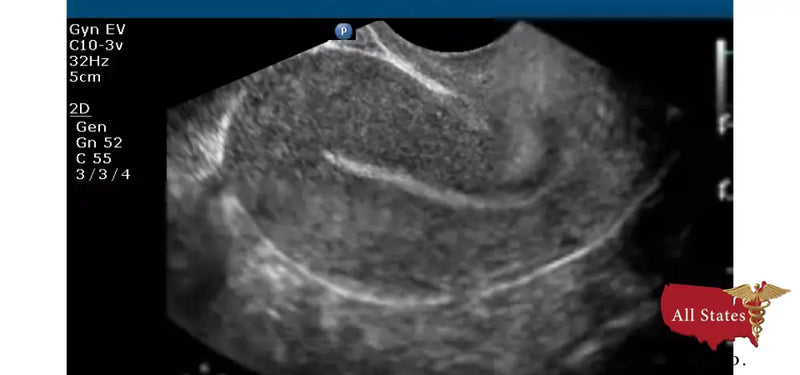 Philips CX50 Refurbished with 3 Probes-Ultrasounds-All States M.E.D.