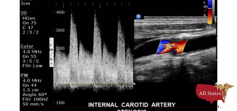 Philips CX50 Refurbished with 3 Probes-Ultrasounds-All States M.E.D.