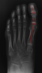 A2D2 Digital Xray With Refurbished Xcel Xray